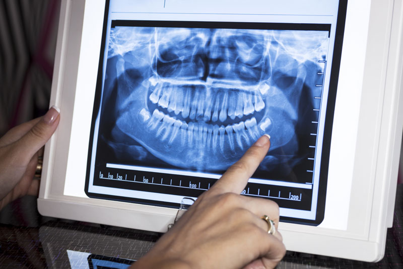 image of a dentist pointing at a patients dental X-Ray for a wisdom tooth extraction