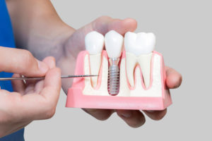 Dental Assistant Showing Off A Dental Implant In A Jawbone Cutaway Model in Bronx, NY