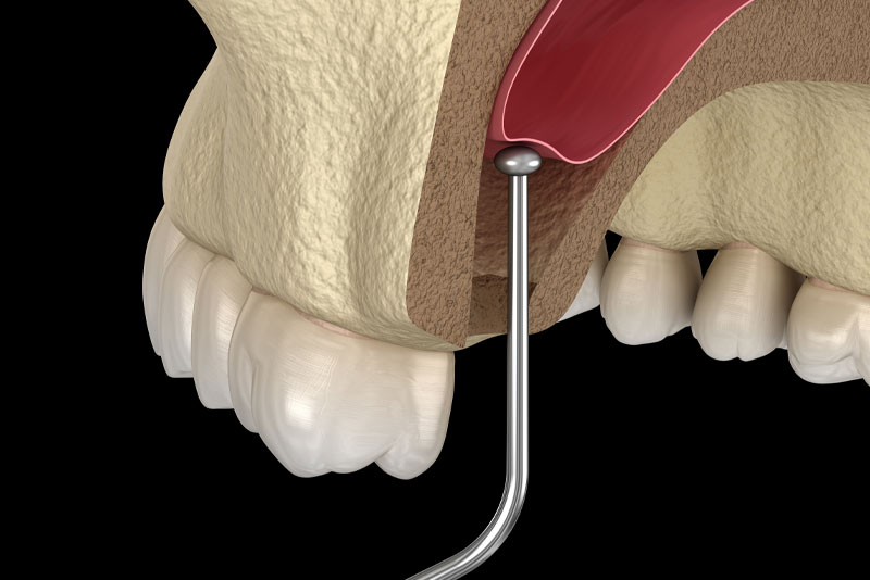 a visualization of a sinus lift on an upper arch