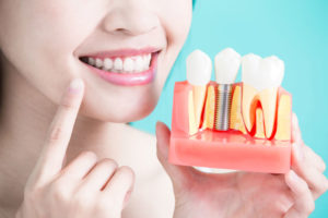 a dental patient posing with a dental implant model while pointing at her smiling mouth