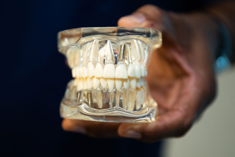 Full mouth dental implant model used to explain pricing and treatment options in Bronx, NY
