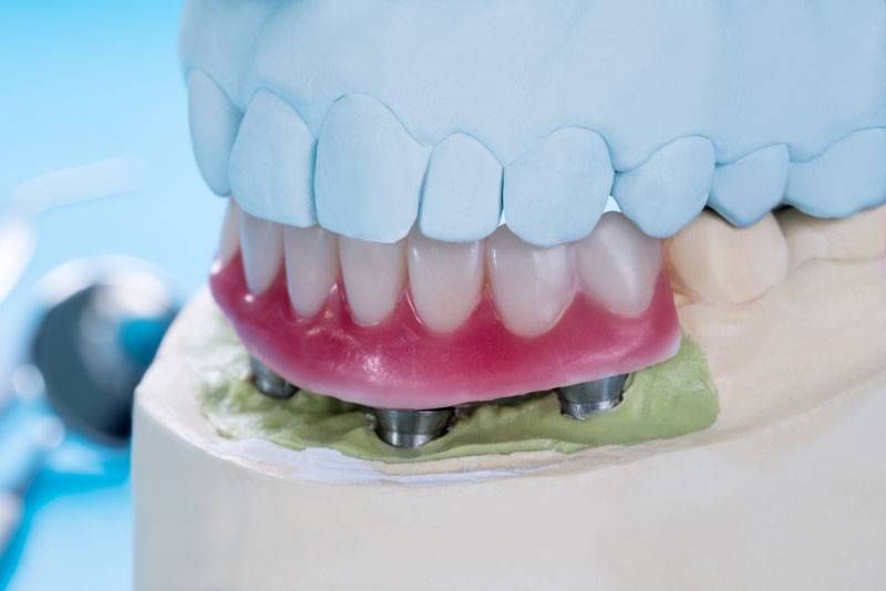 an implant supported denture model all on four implant posts.