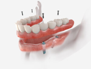 3d Image of a full bottom mouth dental implant denture.