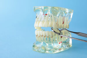 3d image of a dental implant bridge and a prosthesis jaw with a blue backdrop.