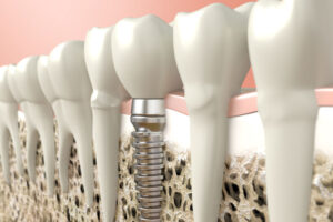 dental implants.