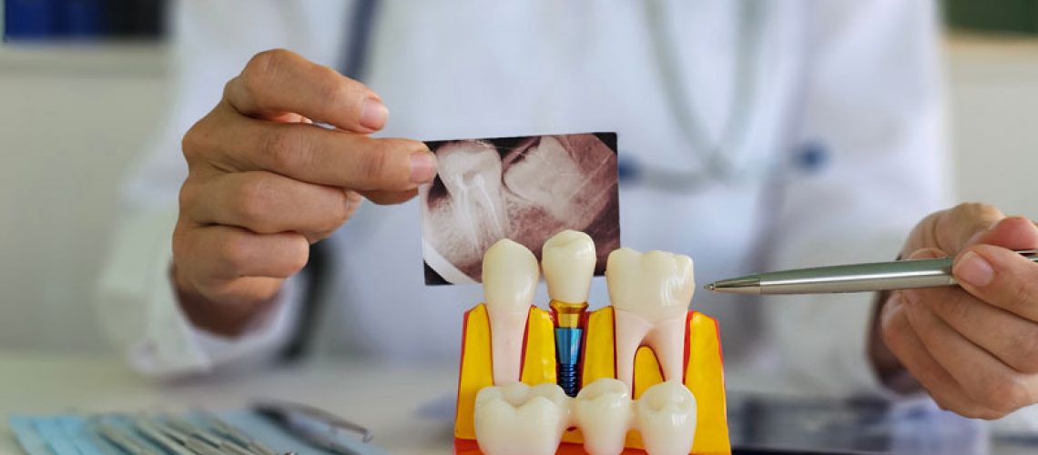 Dental professional examines tooth model and x-ray to assess patient condition and treatment options