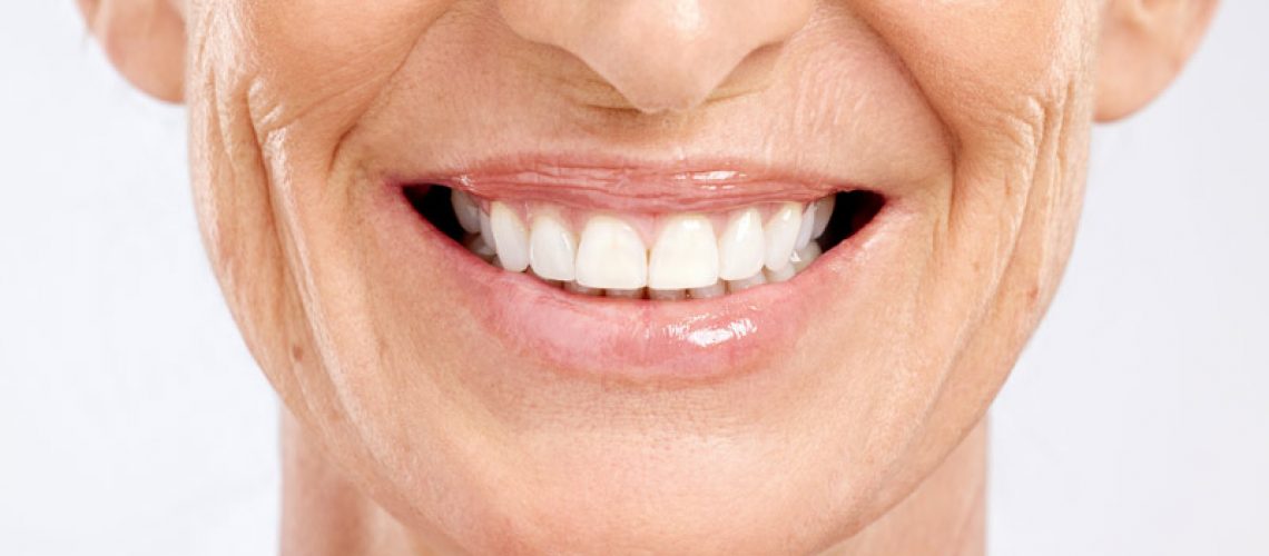 An image of an older woman smiling with porcelain veneers.