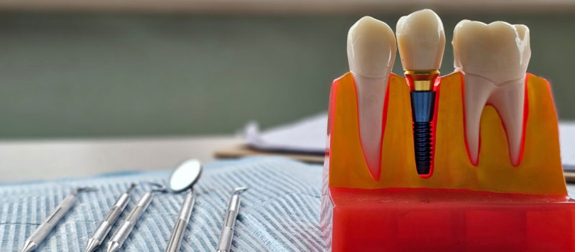 Dental implant, artificial tooth roots into jaw, root canal of dental treatment, gum disease, teeth model for dentist.