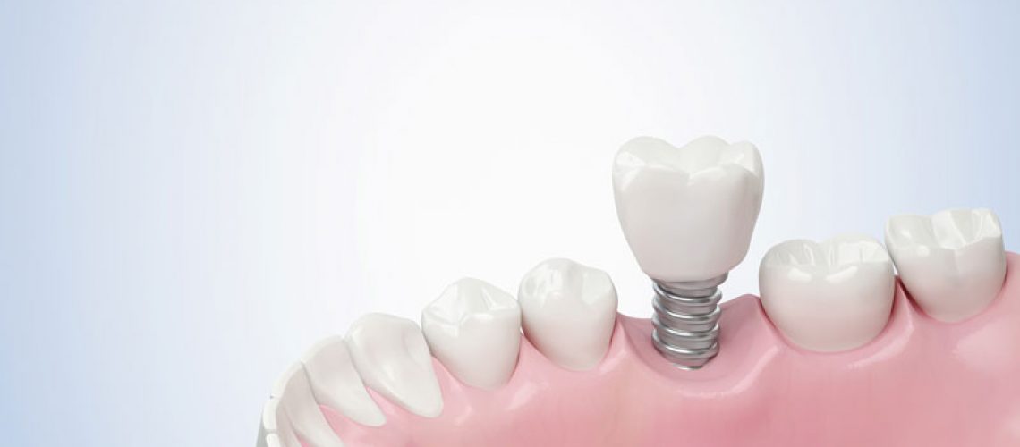 A close-up of a dental implant model showing a white tooth and pink gums illustrates the integration of a dental implant into the jaw for medical education.