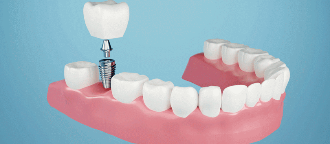 Dental implant, Fix missing teeth with metal screw, teeth crown treatment 3D rendering