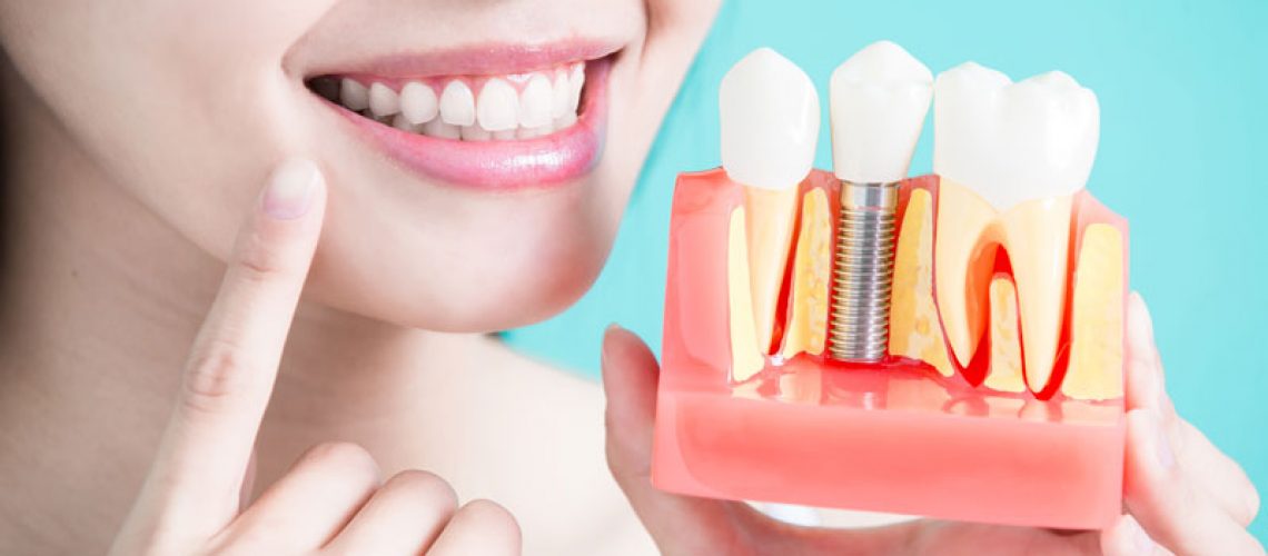 a dental patient posing with a dental implant model while pointing at her smiling mouth