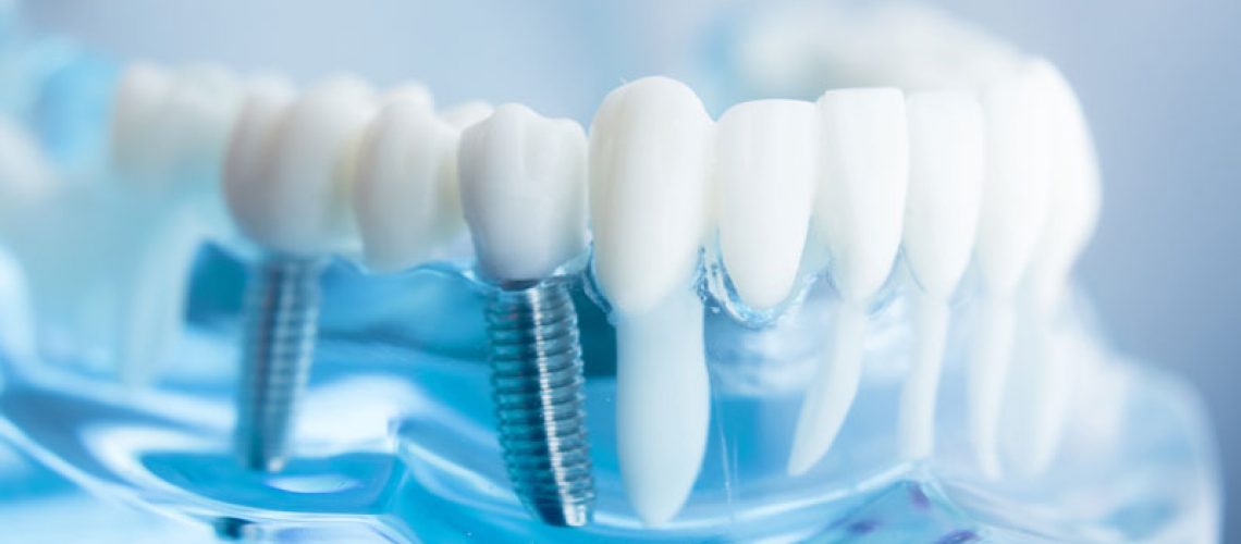 Dental Implant Bridge Model
