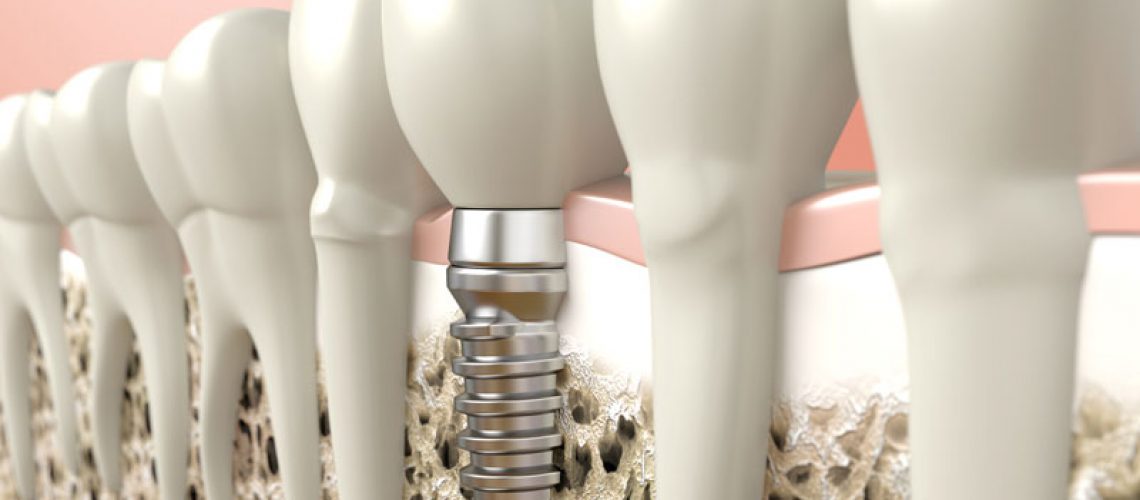 dental implants.