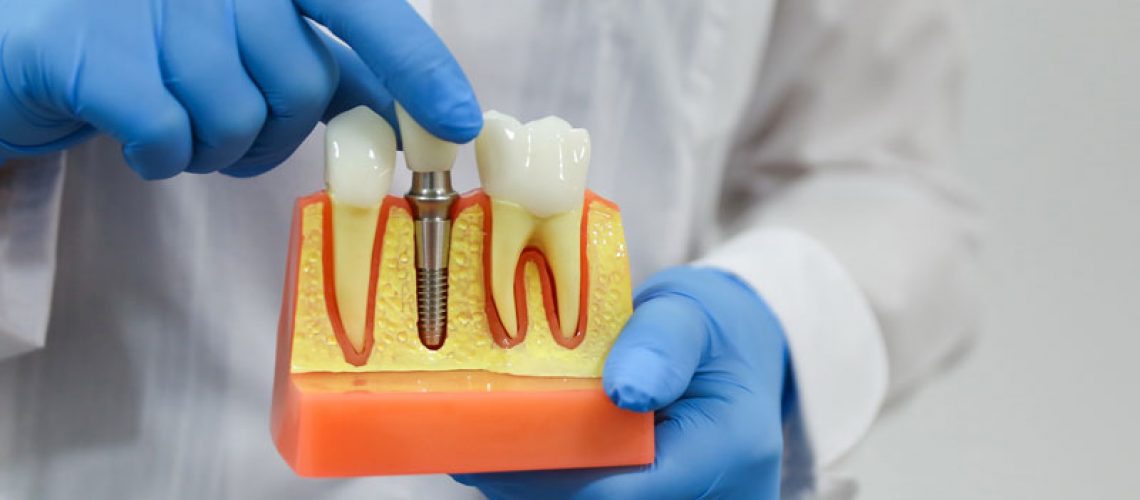 dental implant model of a bone cutaway