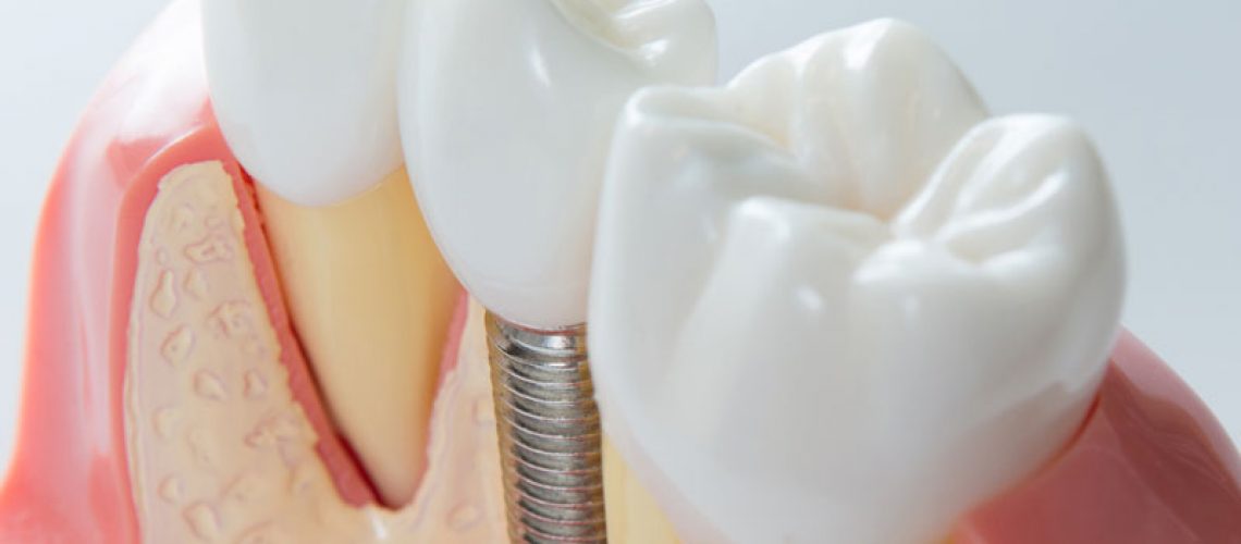 3d model of a dental implant.