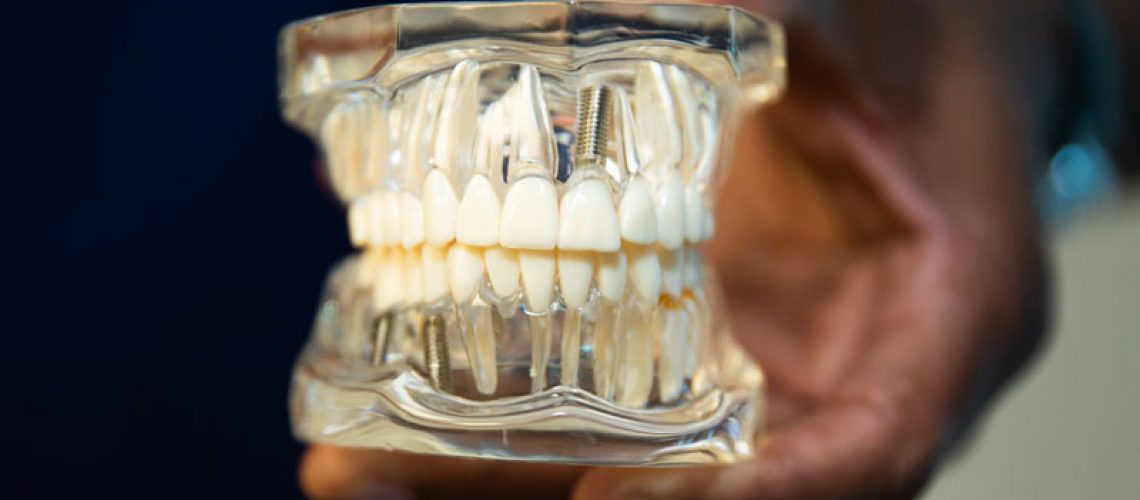 Full mouth dental implant model used to explain pricing and treatment options in Bronx, NY