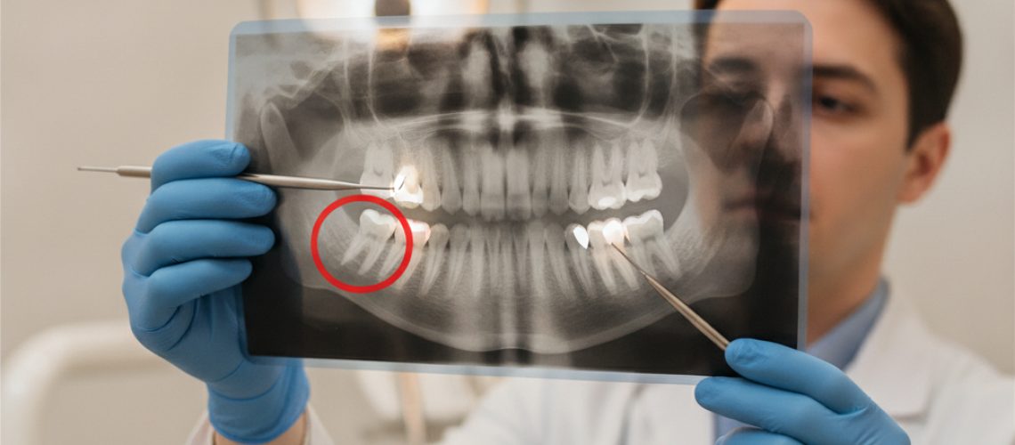 Dentist examining a wisdom tooth x-ray