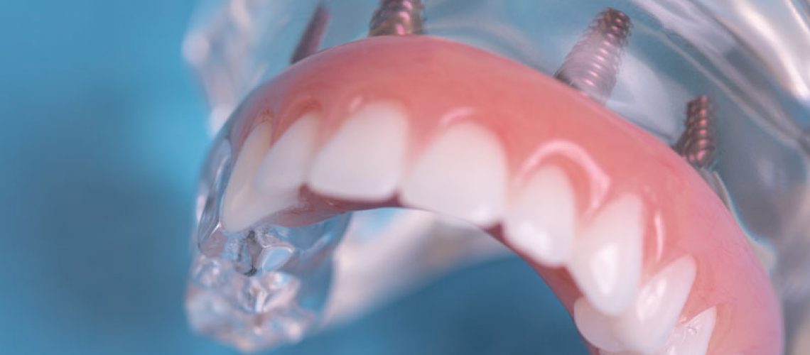 Full Arch Dental Implant Restoration