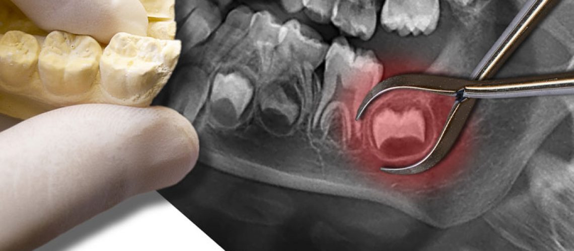 Impacted Wisdom Tooth XRay