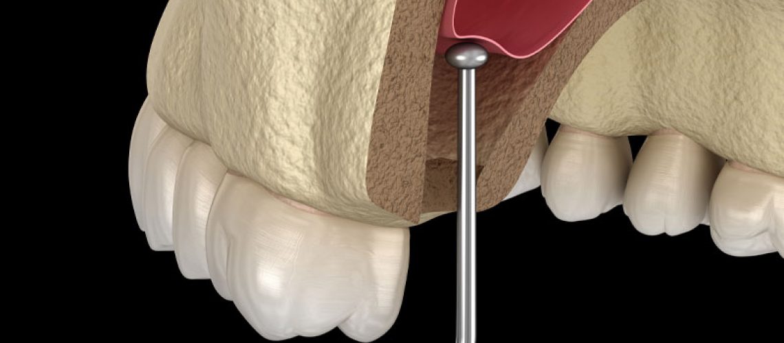 a visualization of a sinus lift on an upper arch